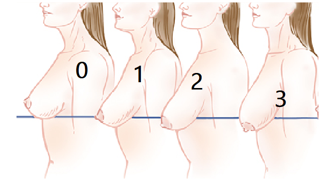 Les différents stades de la ptose mammaire