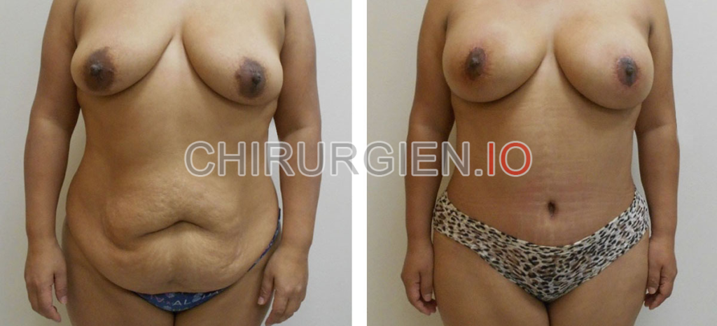 Augmentation mammaire avec lipofilling et abdominoplastie